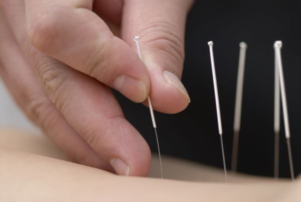 Balance Acupuncture - Traditional Acupuncture